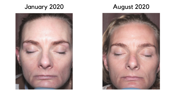 Dorte skin scan result