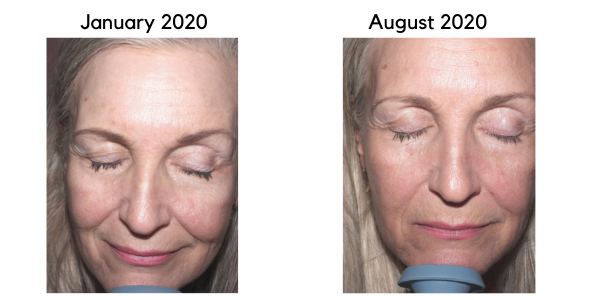 Merete skin scan result